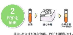 2. PRP分離：本治療専用の遠心分離機と専用キットを用いて遠心しPRPを精製抽出