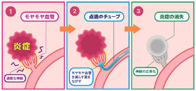 モヤモヤ血管