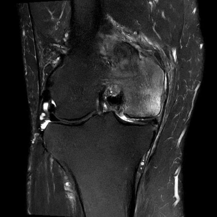 MRI