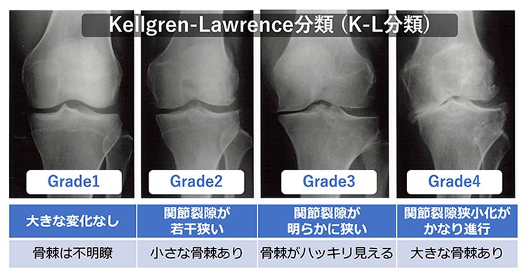PRP療法の適応を判断