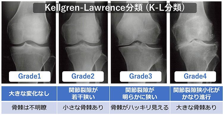 PRP治療のグレードの変化